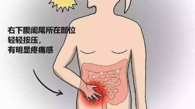 慢性闌尾炎需要切除嗎？