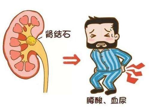 得了腎結石怎么辦？